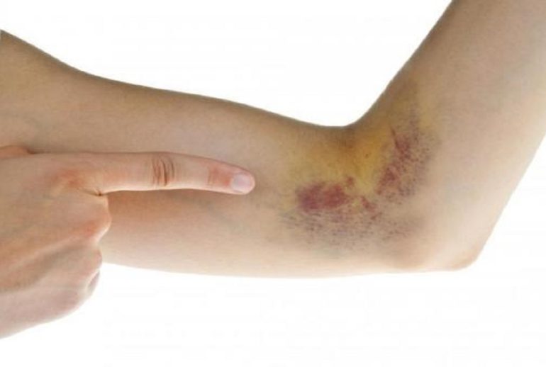 دکتر خونریزی زیر پوستی یا پورپورا - شیراز